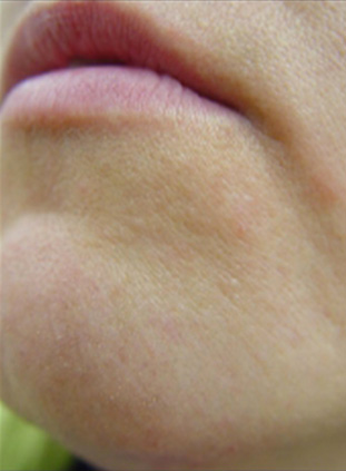 LightSheer Before and After Photo by Torrey Pines Dermatology in La Jolla, California