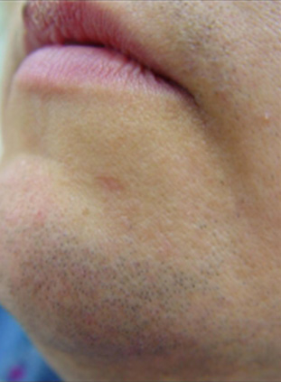 LightSheer Before and After Photo by Torrey Pines Dermatology in La Jolla, California