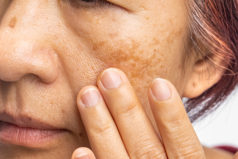 Menopausal women worry about melasma on face