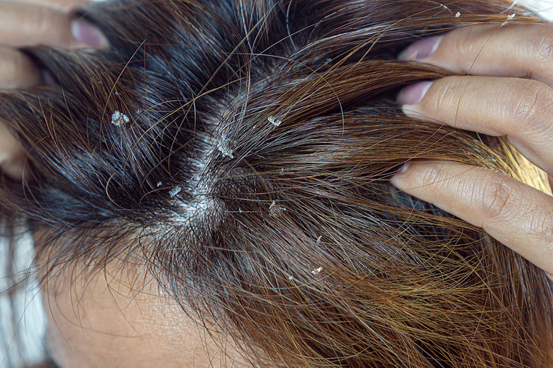closeup hair with dandruff scalp,Seborrheic Dermatitis