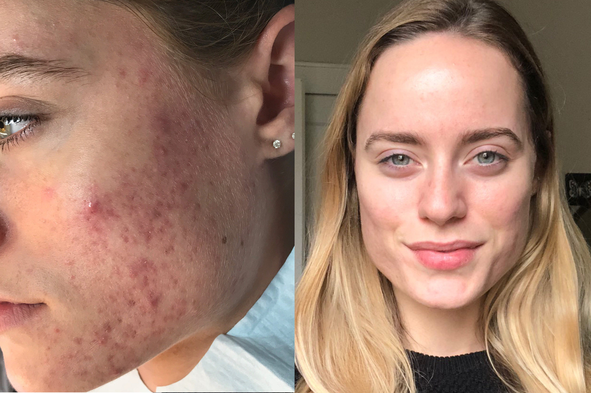 Microneedling Before & After Photos La Jolla