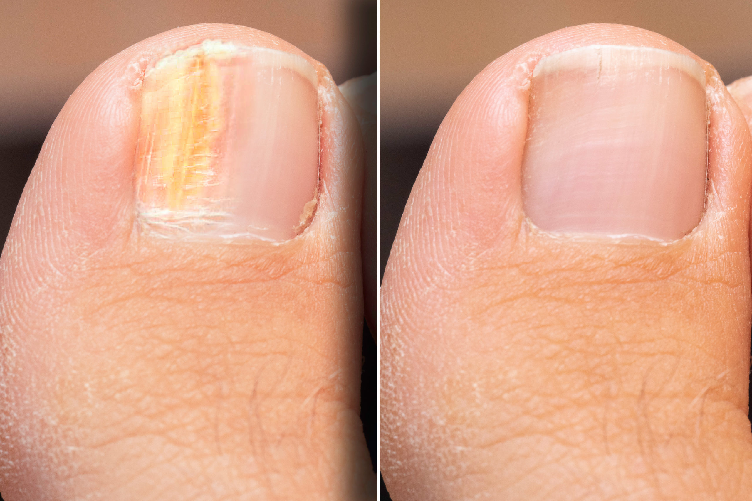 Cutera for Toenail Fungus Before and After Photo by Torrey Pines Dermatology & Laser Center in La Jolla, CA