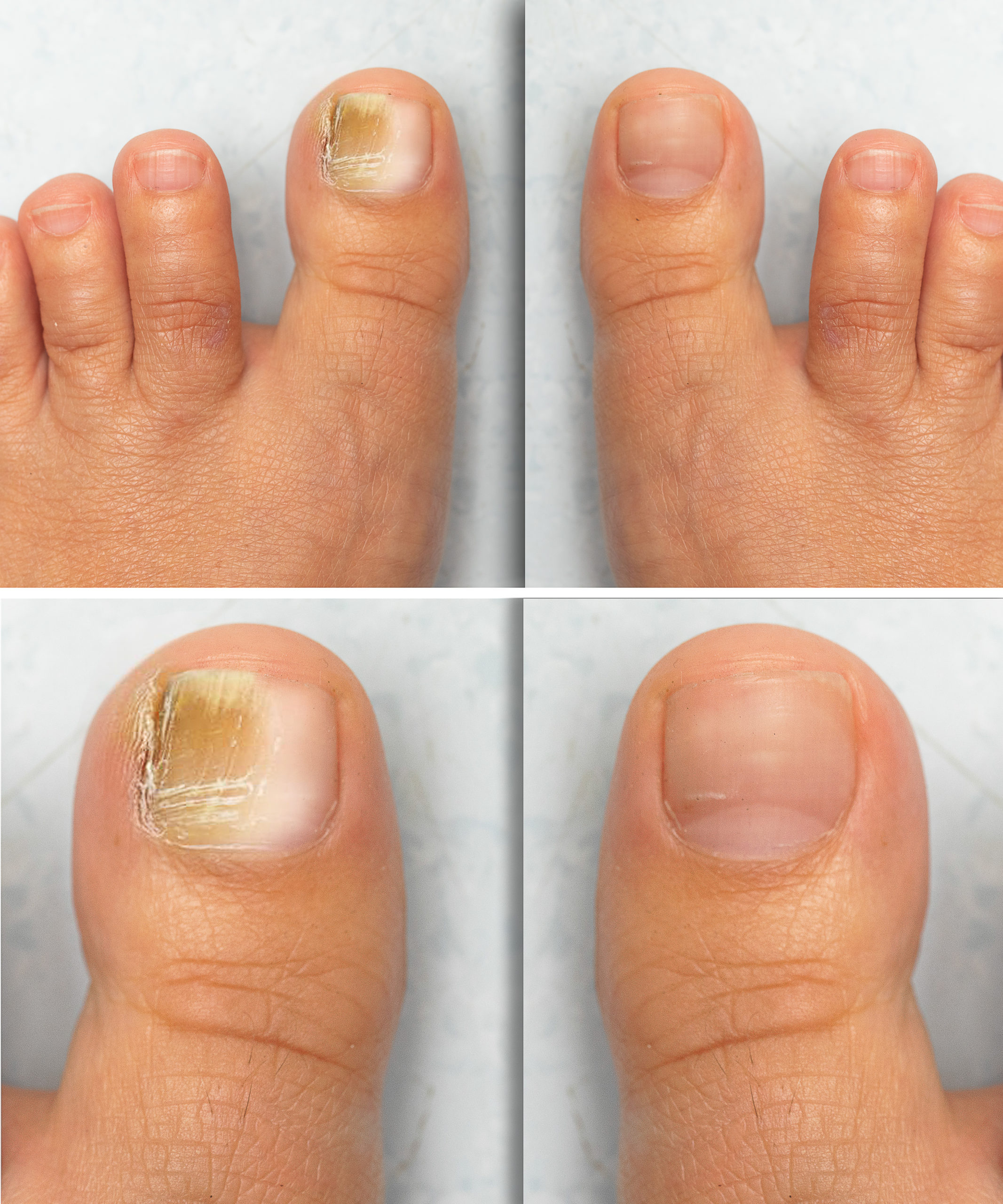 Cutera for Toenail Fungus Before and After Photo by Torrey Pines Dermatology & Laser Center in La Jolla, CA