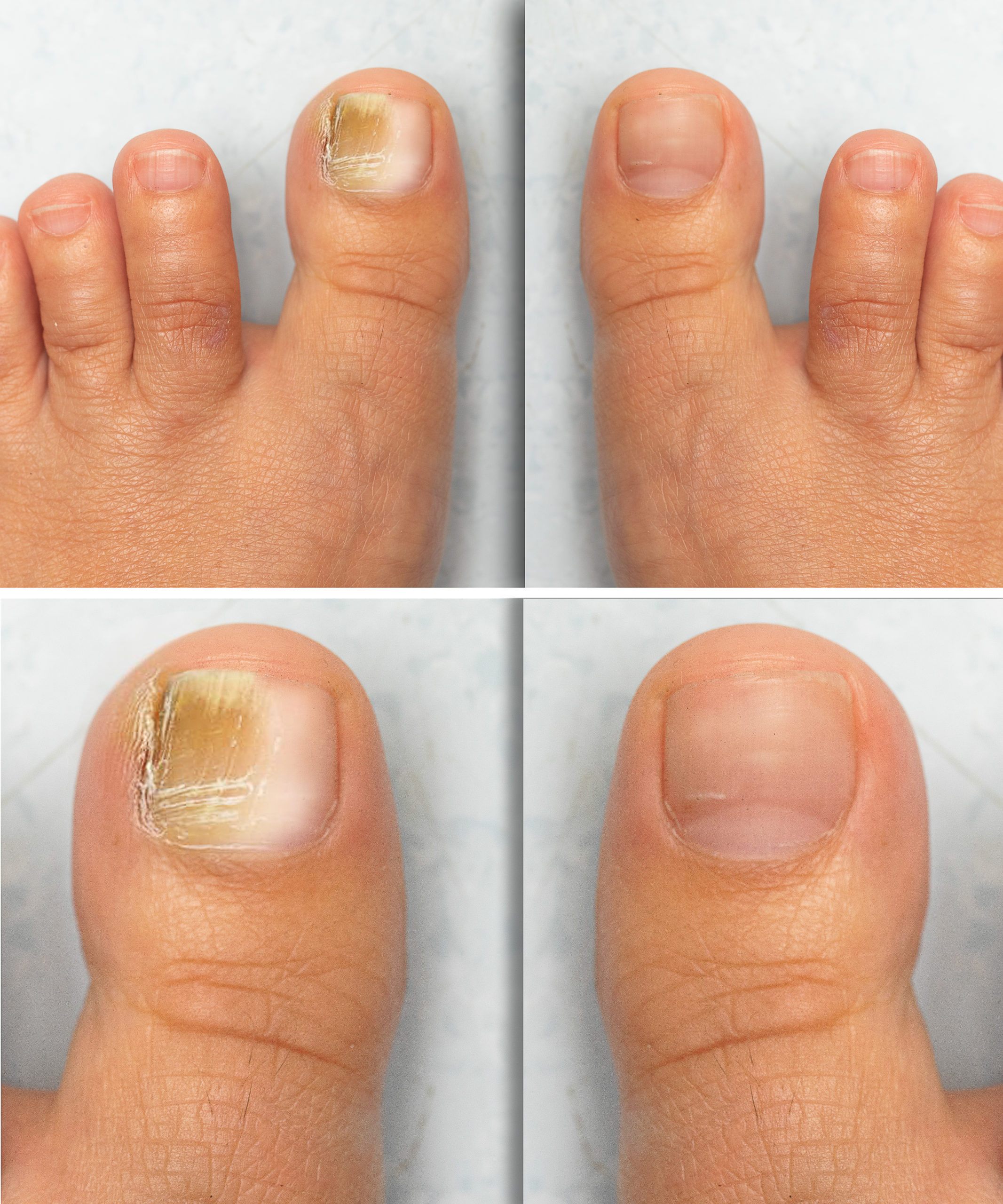 Cutera for Toenail Fungus Archives Torrey Pines Dermatology & Laser