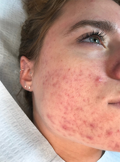Microneedling Before and After Photo by Torrey Pines Dermatology & Laser Center in La Jolla, CA