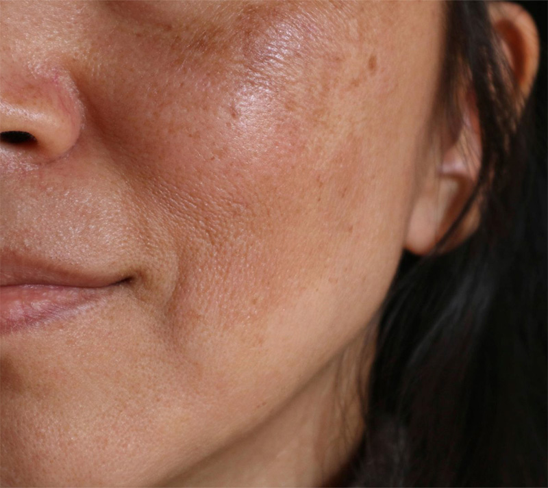 Laser Genesis Before and After Photo by Torrey Pines Dermatology in La Jolla, California