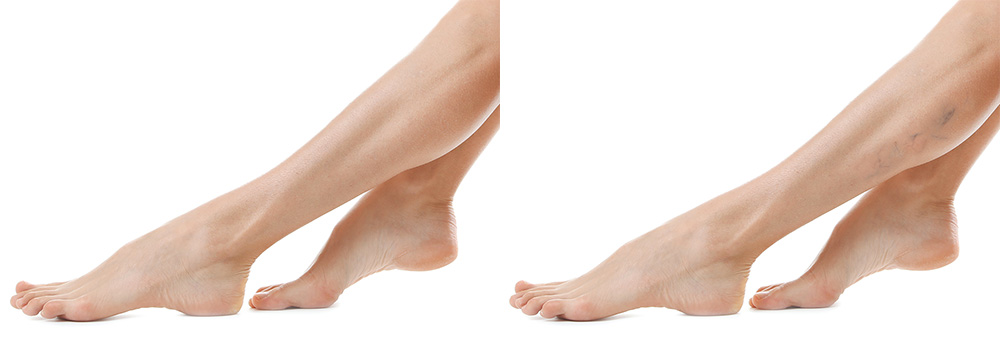 Sclerotherapy Before and After Photo La Jolla, CA