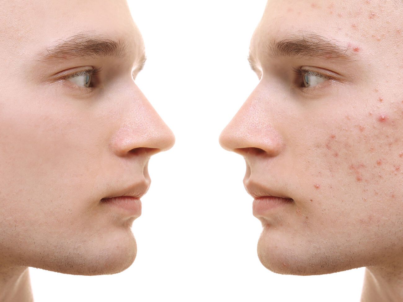 Handsome young man with problem skin on white background