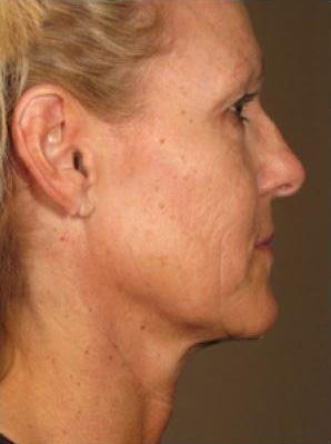 Ultherapy Before and After Photo by Torrey Pines Dermatology in La Jolla, California