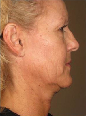 Ultherapy Before and After Photo by Torrey Pines Dermatology in La Jolla, California