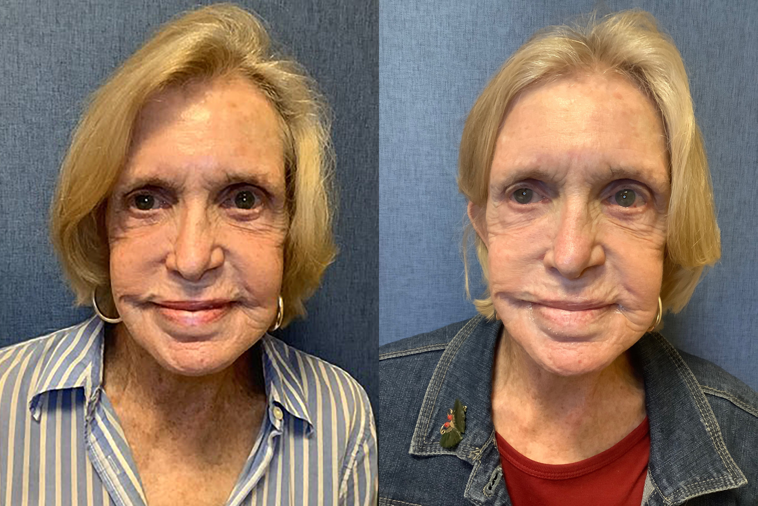 TotalFX Before and After Photo by Torrey Pines Dermatology & Laser Center in La Jolla, CA