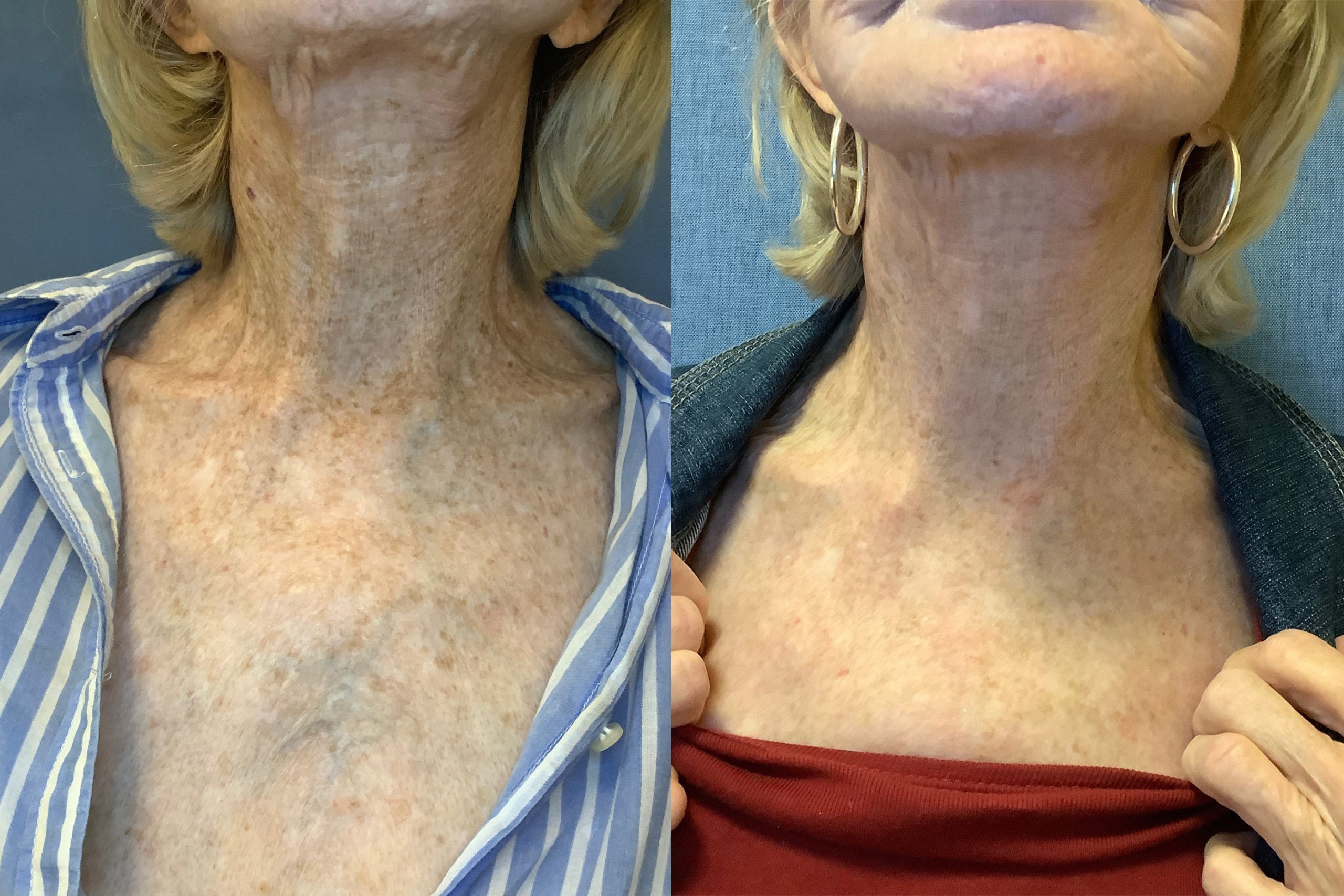 TotalFX Before and After Photo by Torrey Pines Dermatology & Laser Center in La Jolla, CA